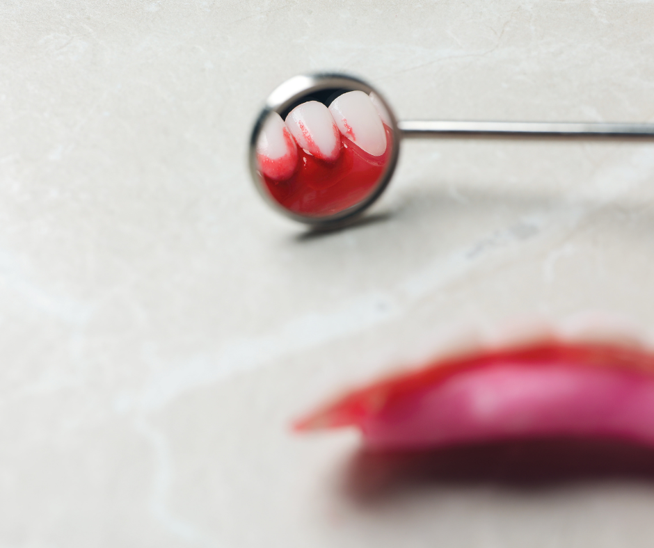 Dentist-using-a-small-mirror-to-examine-a-tooth-and-gums-for-signs-of-gum-disease.png