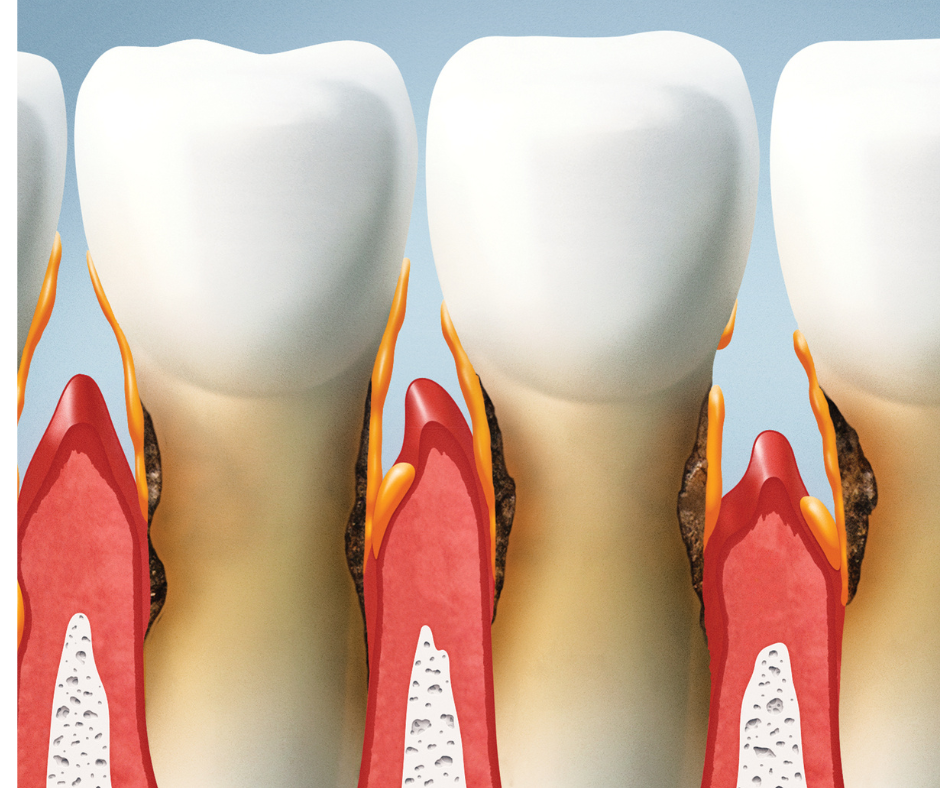 Graphic-showing-an-internal-view-of-a-tooth-and-gum-diseases-structure.png