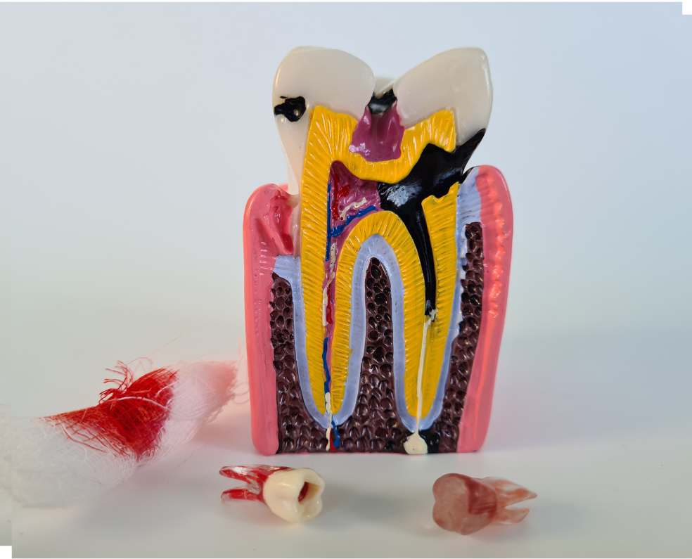 Image-of-a-large-model-tooth-displaying-internal-decay-and-cavity-areas-with-two-real-affected-teeth-held-in-front-for-comparison-e1720076672193.png