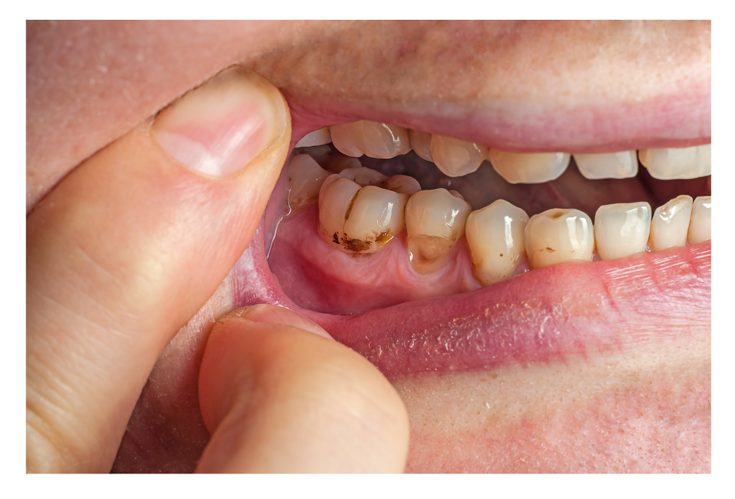 Image-of-a-person-displaying-teeth-visibly-affected-by-decay-and-cavities-e1720075598657.png